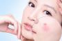 Giải cứu cho làn da mụn mùa hanh khô với tuyệt chiêu sau